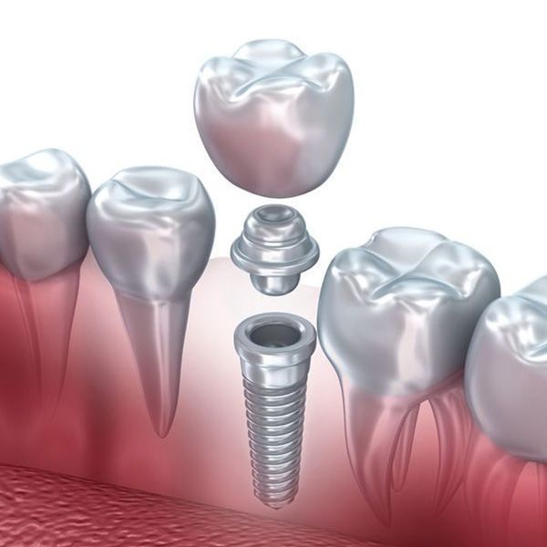 Illustration of jaw and parts of an implant